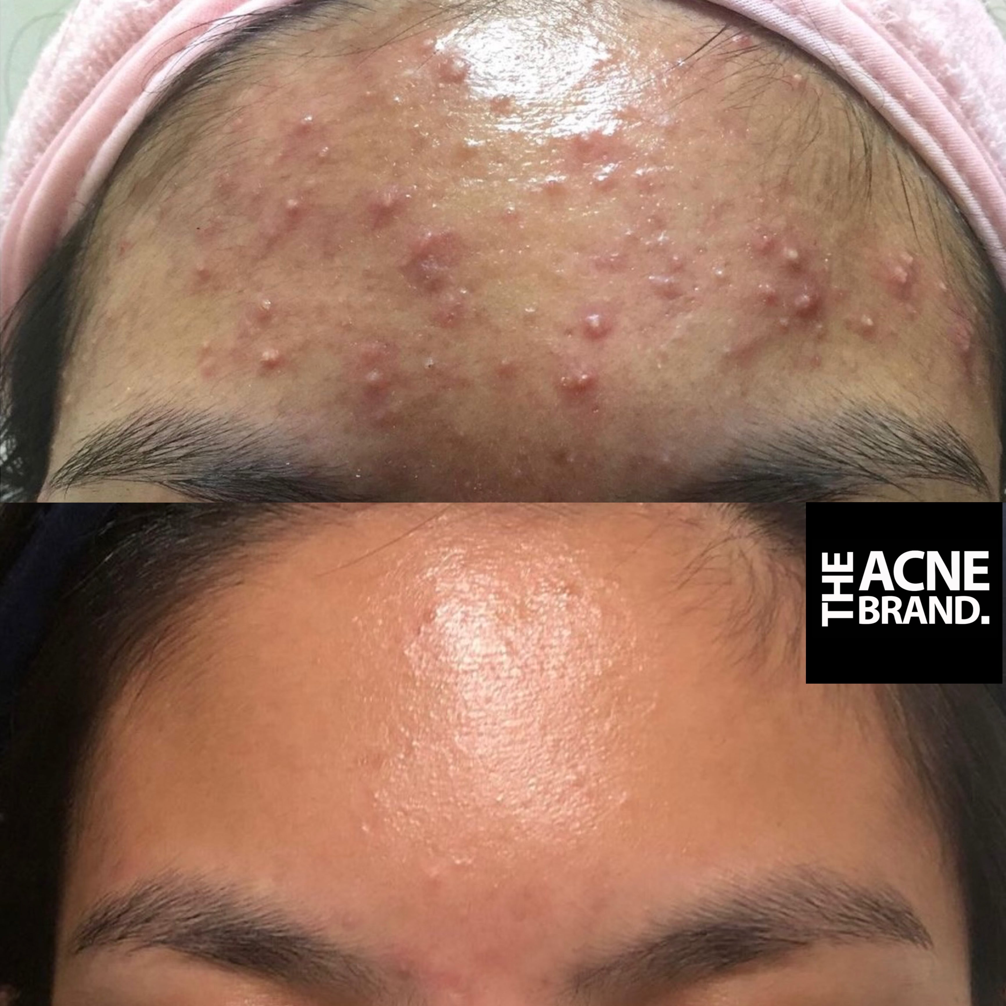 THE ACNE CLAY MASK – THE ACNE BRAND.